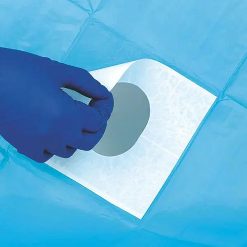 Ein blaues steriles Abdecktuch mit einer runden Öffnung in der Mitte ist zu sehen. Eine Hand mit einem blauen Handschuh hebt vorsichtig eine Klebefolie am Rand der Öffnung an.